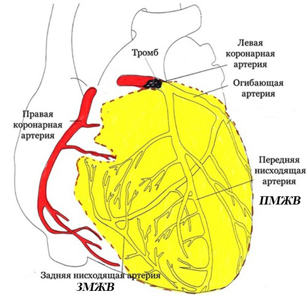 Лечение инфаркта миокарда в Красноярске