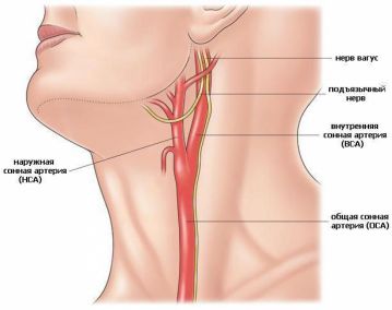 Атеросклеротические стенозы сонных артерий как причина мозгового инсультa